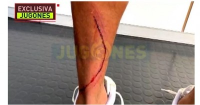 La cicatriz en la pierna izquierda de Marvin, tras la patada de Machís Real madrid.JPG