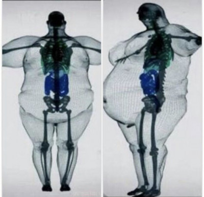 obesidad sobrepeso y esqueleto.jpeg